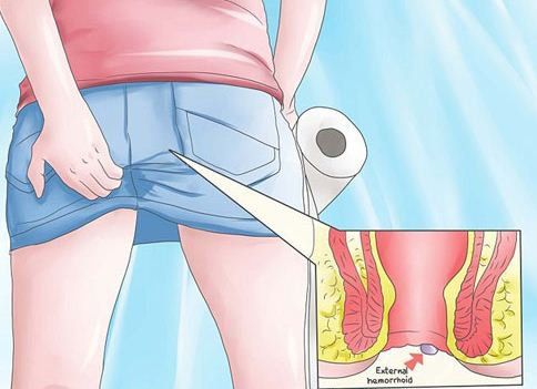 How to Make Sugar Paste for Hemorrhoids