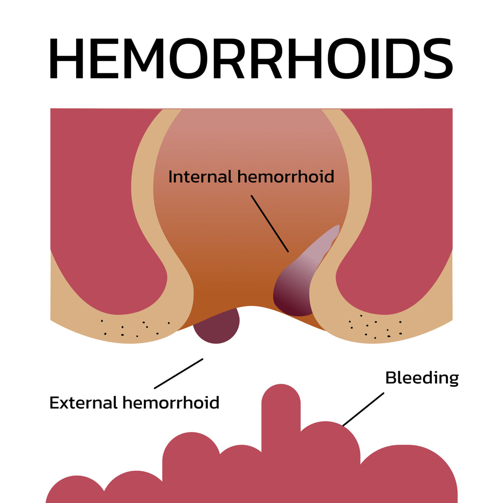 Understanding the Sensation of Internal Hemorrhoids