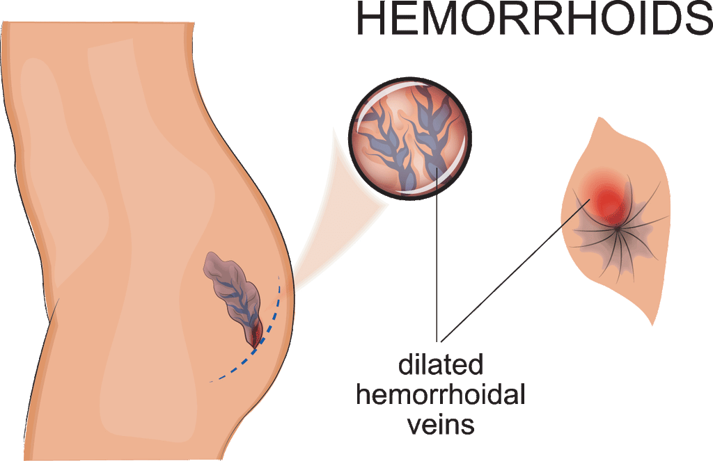 how to get rid of internal hemorrhoids